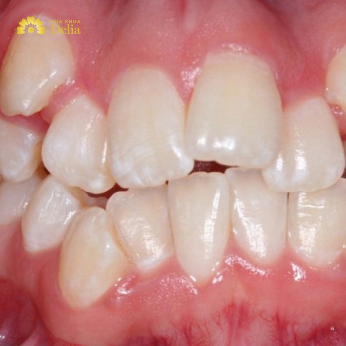 Các thói quen không tốt trong quá trình phát triển răng miệng có thể gây ra tình trạng răng nhai mọc lệch