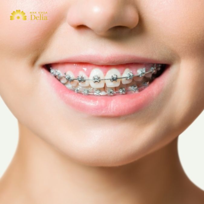 Chỉnh nha niềng răng là phương pháp phổ biến nhất để điều chỉnh các vấn đề về sự lệch lạc của răng