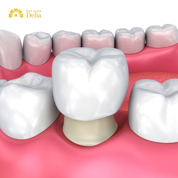Bọc răng sứ là phương pháp điều trị răng nhai bị mọc lệch hoặc hư tổn nghiêm trọng
