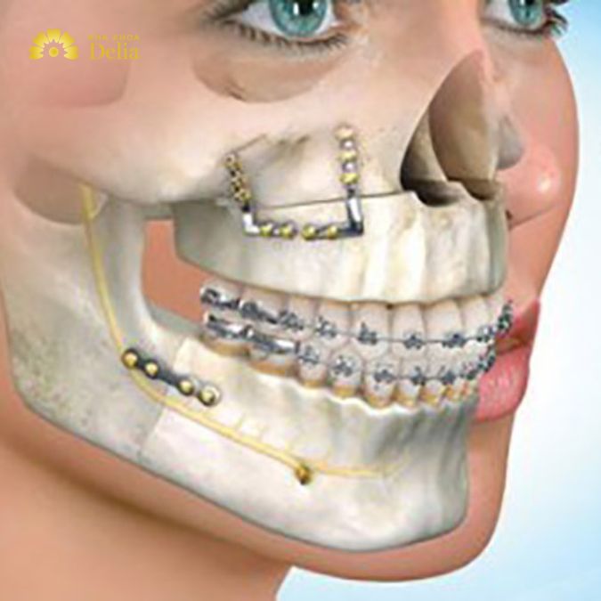 Đối với những trường hợp răng nhai mọc lệch nghiêm trọng mà không thể điều trị bằng các phương pháp như niềng răng hoặc bọc sứ, phẫu thuật chỉnh hàm có thể cần thiết.