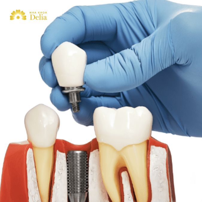 How much does same day dental implant cost, expensive or cheap?