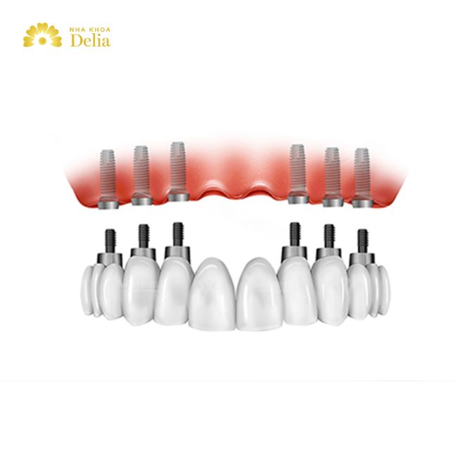 How much do All-on-6 dental Implants cost in Thailand?