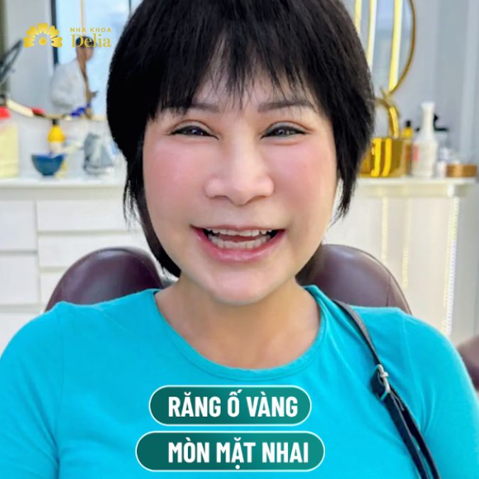 Chị Kim đến nha khoa Delia với hàm răng ố vàng và thưa kẽ.