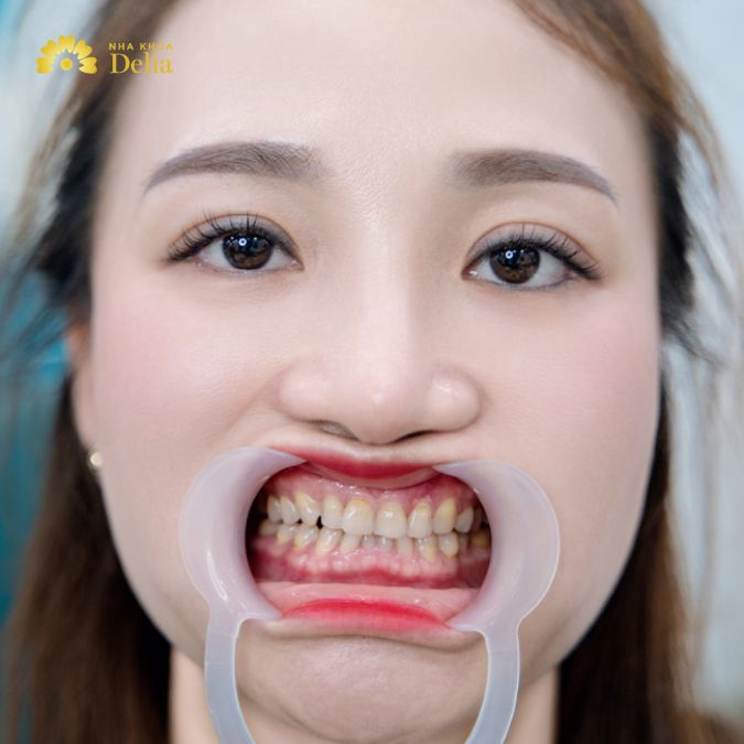 Hình ảnh răng chị Thủy trước khi đến với Delia