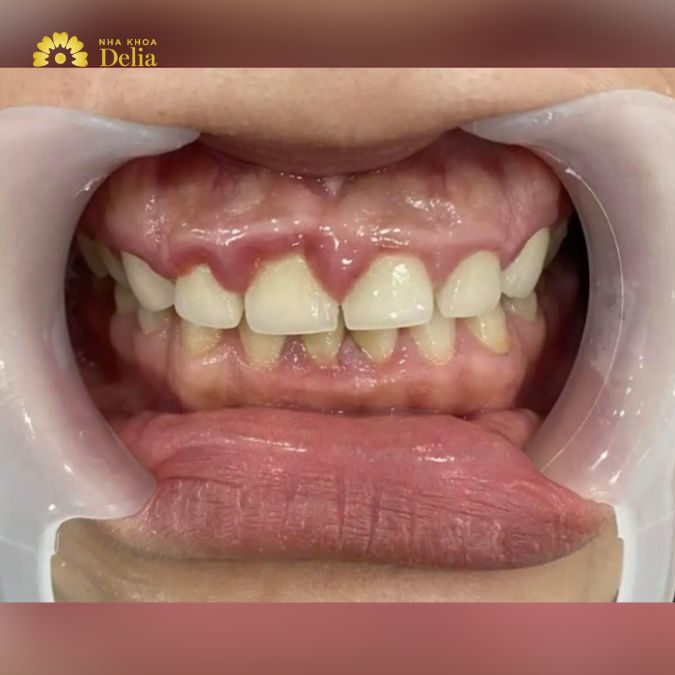 Chị Phương đã từng tự ti vì hàm răng không được đẹp