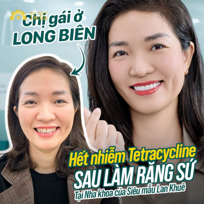 Chị gái ở Long Biên hết nhiễm Tetracycline sau khi làm răng sứ tại Delia
