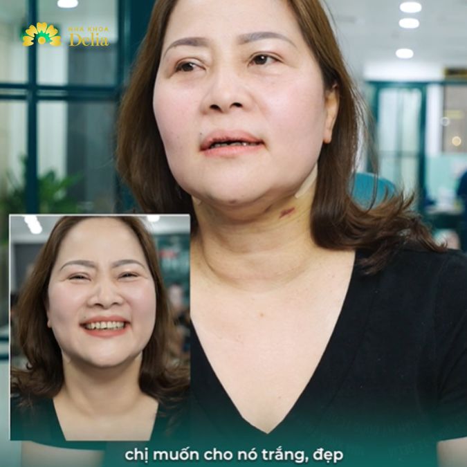 Răng vàng, xỉn màu lâu năm khiến chị Bình tự ti
