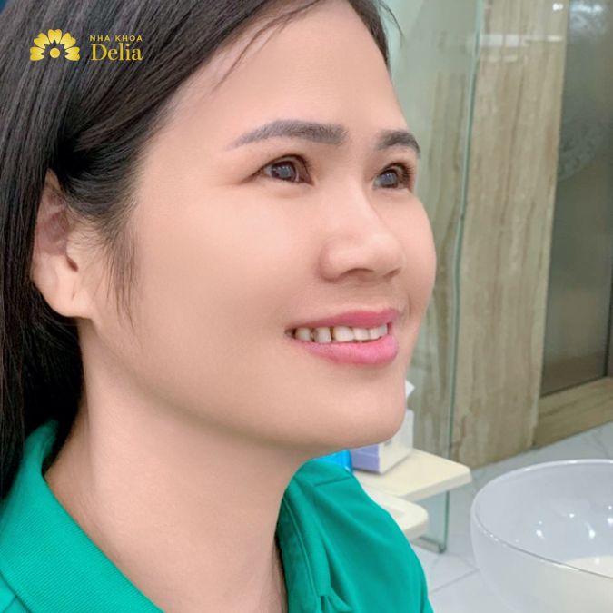 Chị Hoa từng trải qua nhiều lần tráng men tại các nha khoa ở Bắc Giang nhưng không thành công