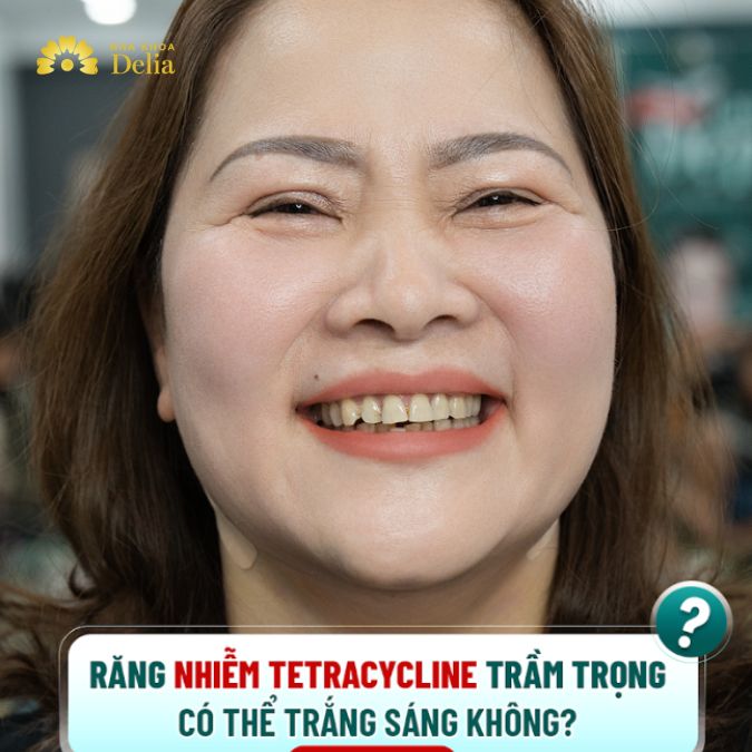 Răng nhiễm Tetracycline trầm trọng có thể trắng sáng không?