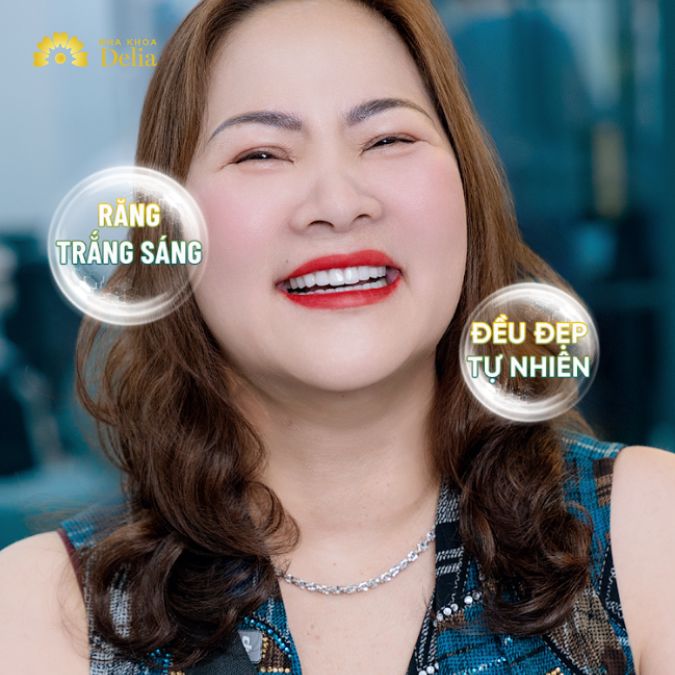 Chị Thanh Bình chọn giải pháp bọc 20 răng sứ Emax, vật liệu cao cấp cho hiệu quả thẩm mỹ và độ bền vượt trội.