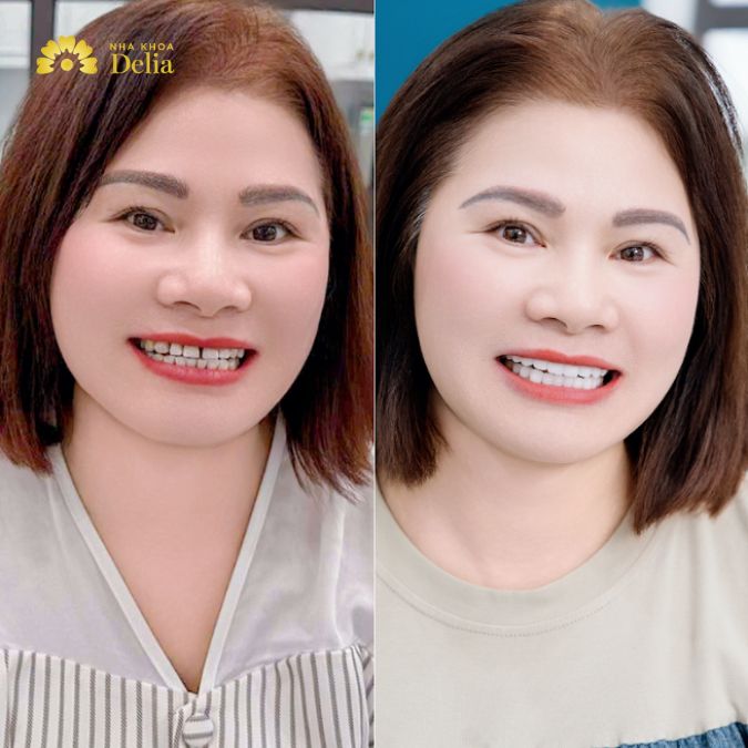 Hình ảnh trước và sau khi làm răng của chị Đào
