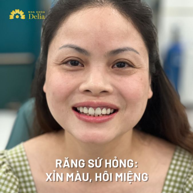 Răng sứ cũ xỉn màu, hôi miệng