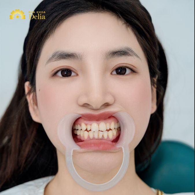 Chị Kim Anh đã phải sống chung với hai chiếc răng thỏ không đều, dẫn đến việc chị thường xuyên phải mím môi, không dám cười tự nhiên.