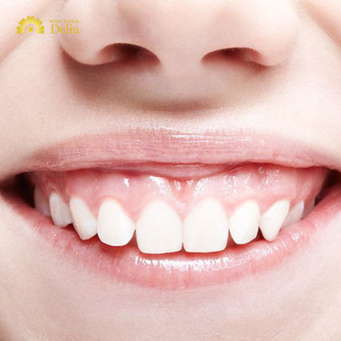 Nguyên nhân khiến khuôn miệng cười không đẹp
