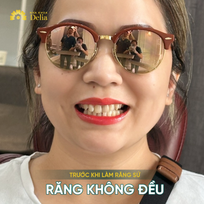Hàm răng ố vàng khiến chị Vân tự ti khi giao tiếp