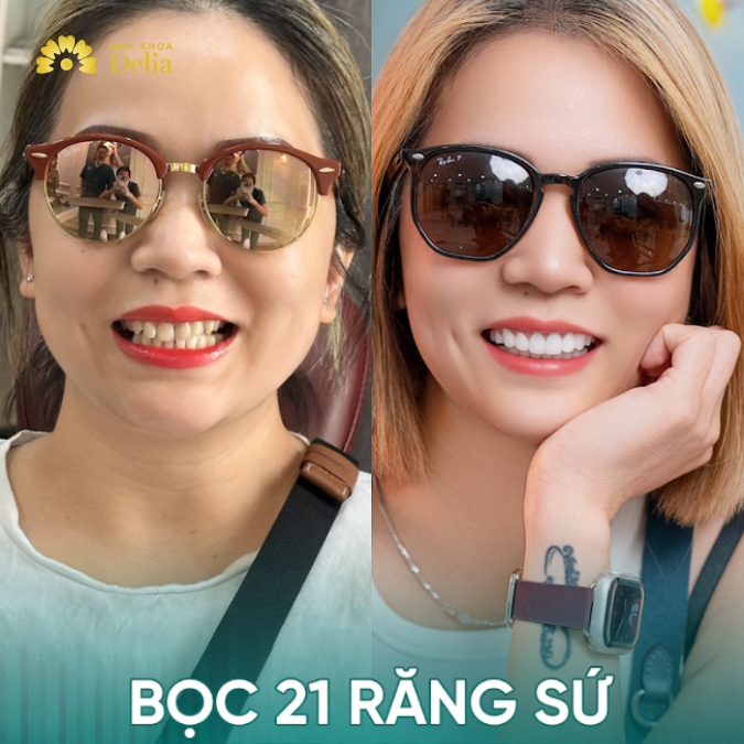 Chị Vân đã lựa chọn làm răng sứ Nacera Q3 Burn, một trong những dòng răng sứ cao cấp đến từ Đức