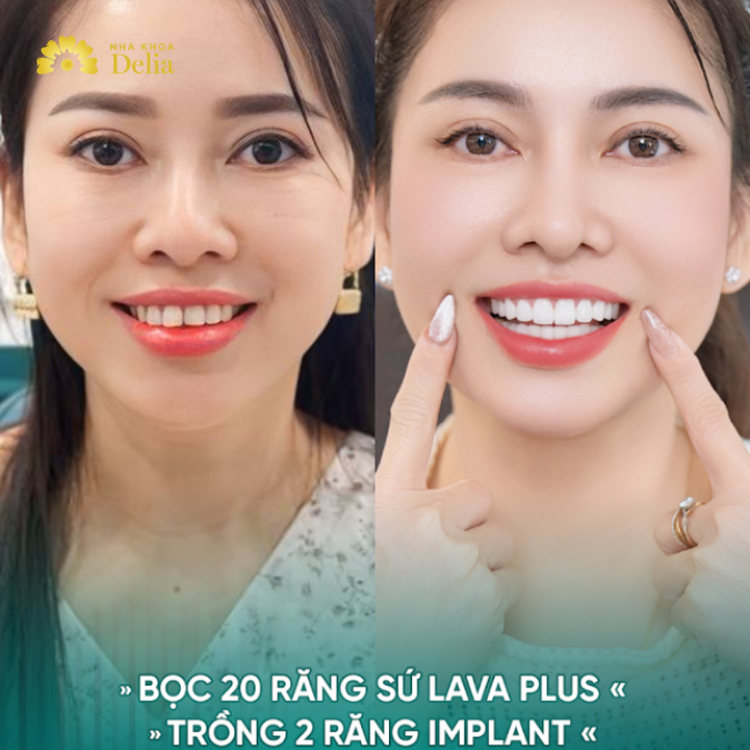 Sau khi hoàn tất việc điều trị, chị Oanh không khỏi bất ngờ trước sự thay đổi của mình.