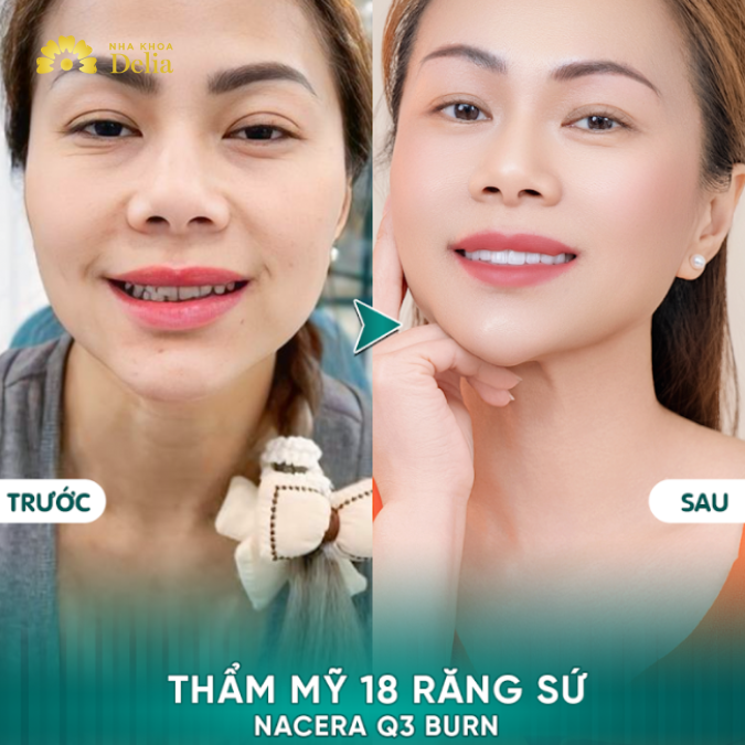 Chị Cianna quyết định thực hiện bọc răng sứ để cải thiện màu sắc và hình dáng của răng