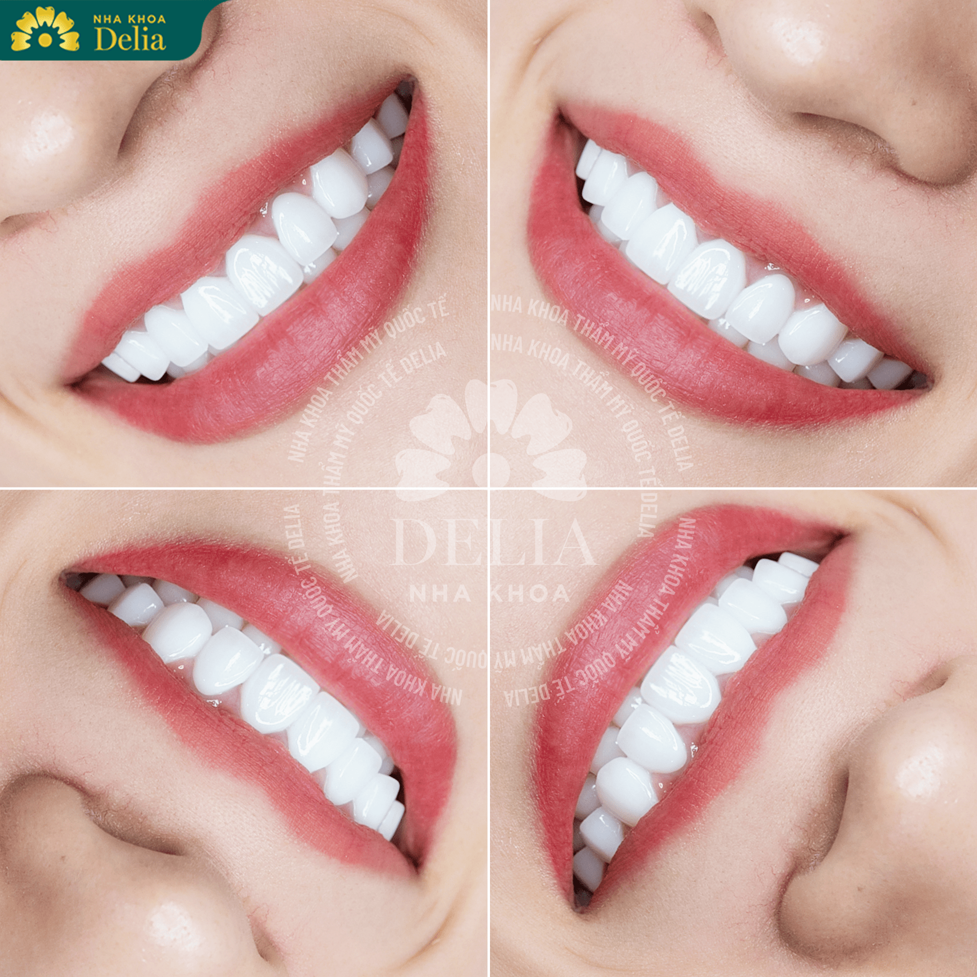 Lợi ích khi bọc răng sứ tại Delia