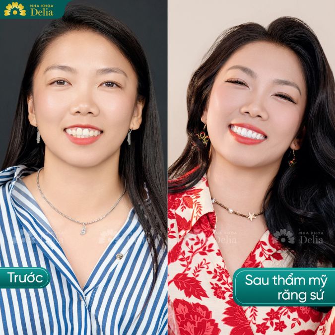Một hàm răng trắng sáng, đều đẹp tự nhiên, không còn tình trạng hở lợi là những gì mà Huỳnh Như đã nhận được